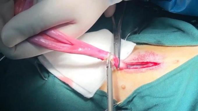 กรณี บริษัท ล่าสุดเกี่ยวกับ การใช้มีดผ่าตัดอัลตราโซนิกสำหรับสัตว์เลี้ยงในการทำหมันแมวและการทำหมัน | ศ 0