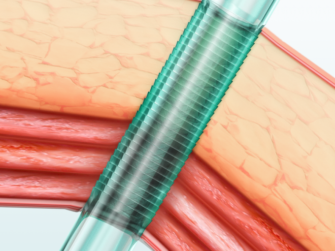 ข่าว บริษัท ล่าสุดเกี่ยวกับ คุณสมบัติและประโยชน์ของ Trocar ส่องกล้องแบบใช้แล้วทิ้ง Endopass | ศจ  0