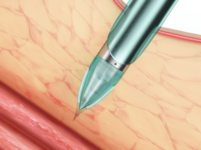 ข่าว บริษัท ล่าสุดเกี่ยวกับ คุณสมบัติและประโยชน์ของ Trocar ส่องกล้องแบบใช้แล้วทิ้ง Endopass | ศจ  1