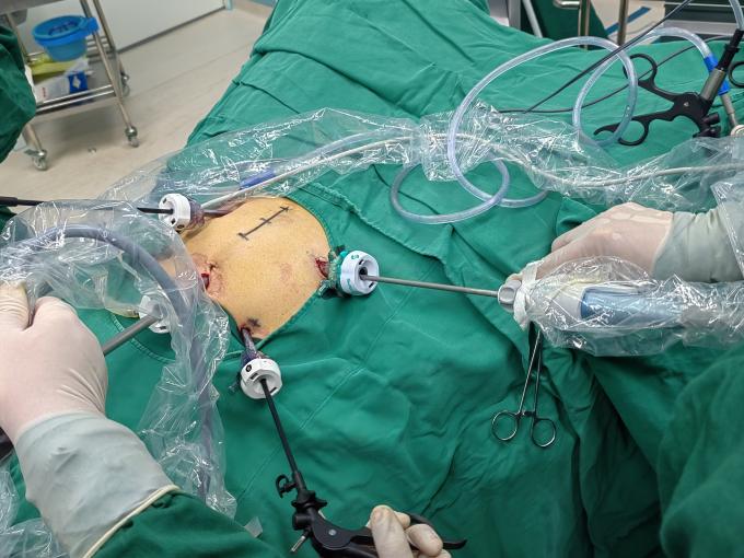 กรณี บริษัท ล่าสุดเกี่ยวกับ SurgSci Trocar ส่องกล้องและ Ultrasonic Scalpel Use Case | ศ 1