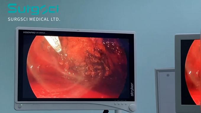 กรณี บริษัท ล่าสุดเกี่ยวกับ มีดผ่าตัดอัลตราโซนิก SurgSci ในการใช้งาน | ไส้เลื่อนรีแพร์ | ศ  0